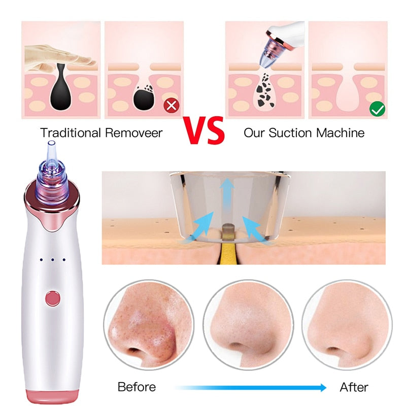 Aspirador de poros - Removedor de cravos - Sucção contra Acne - Peeling e Limpeza facial - Microdermoabrasão de Diamante.